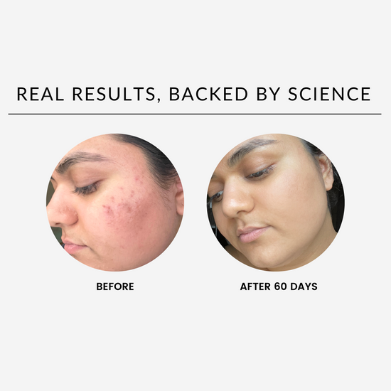 Skincare_SHAYDE_Beforeandafter_BEAUTY